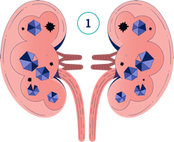 Kidney Stones Illustration