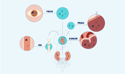 Illustration Oxalose systémique